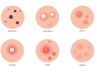 Pengertian Jerawat : Epidemiologi, Faktor Resiko, Etiologi, Patogenesis dan Tingkatan Jerawat