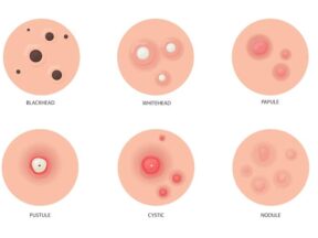 Pengertian Jerawat : Epidemiologi, Faktor Resiko, Etiologi, Patogenesis dan Tingkatan Jerawat