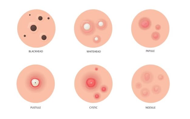Pengertian Jerawat : Epidemiologi, Faktor Resiko, Etiologi, Patogenesis dan Tingkatan Jerawat